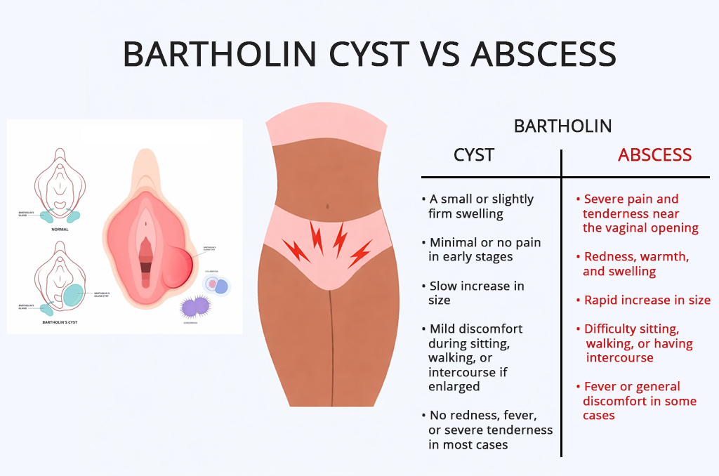 bartholin cyst vs abscess key differences and treatment approaches