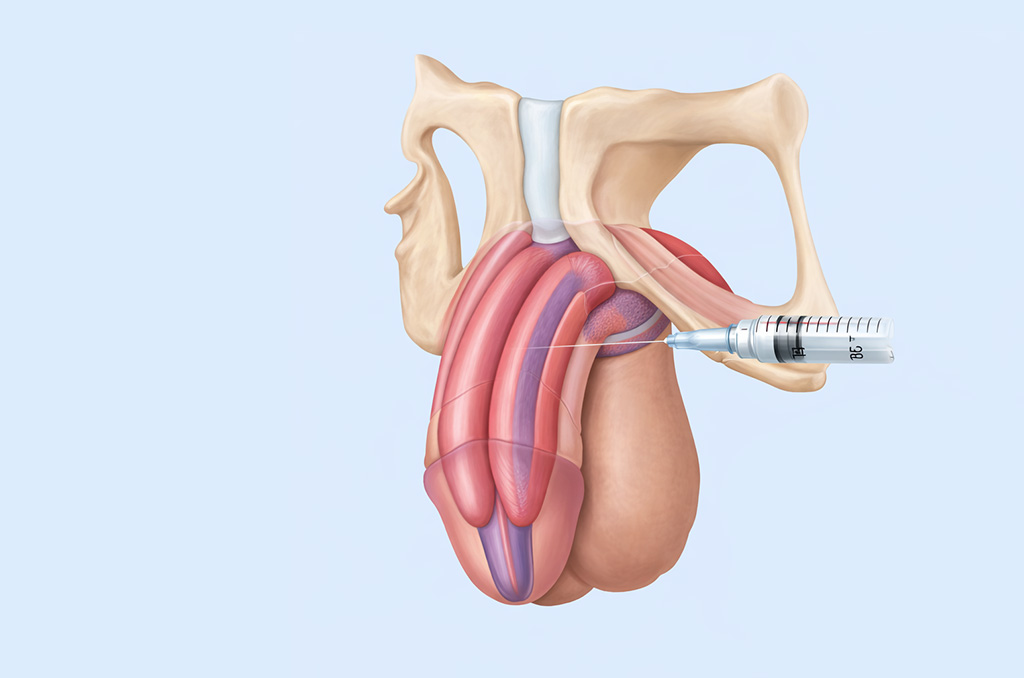 how p spot treatment can enhance intimate confidence and pleasure