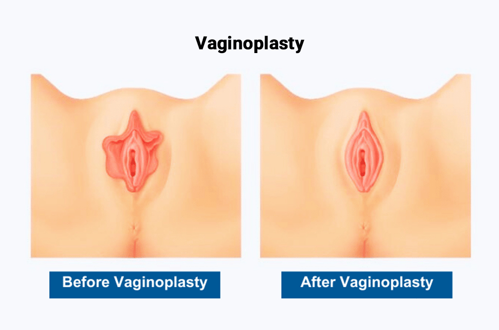vaginoplasty procedure step by step guide for women considering surgery
